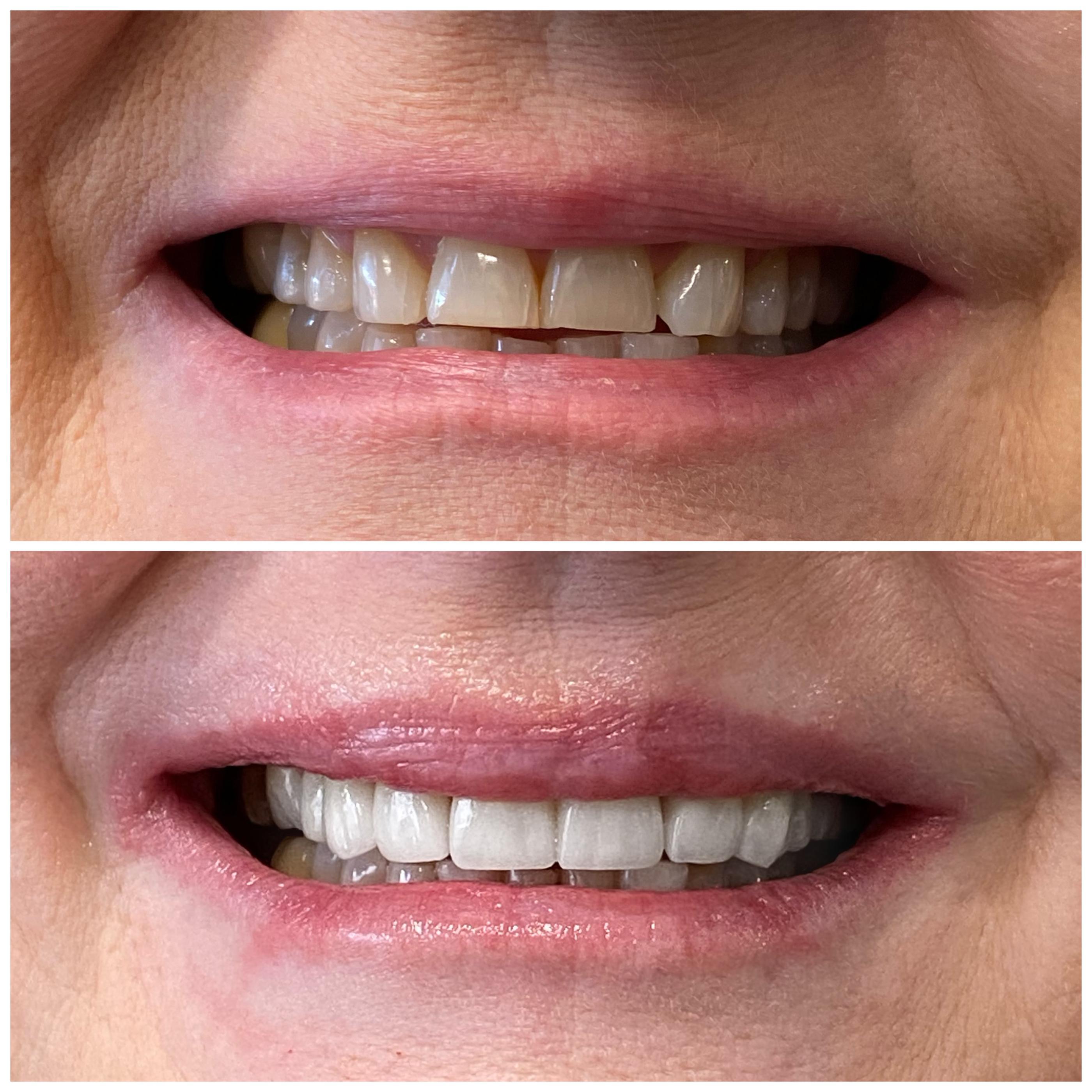 before and after porcelain veneers at Pristine Smiles